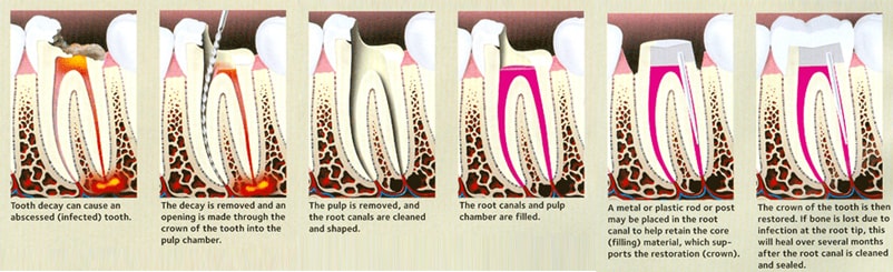Root Canals Olney Dental Montgomery County Maryland